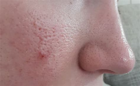 Severely enlarged pores – General acne discussion – Acne.org Forum