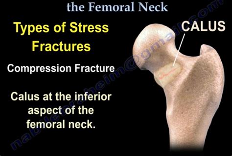 Femoral Neck Stress Fractures — OrthopaedicPrinciples.com