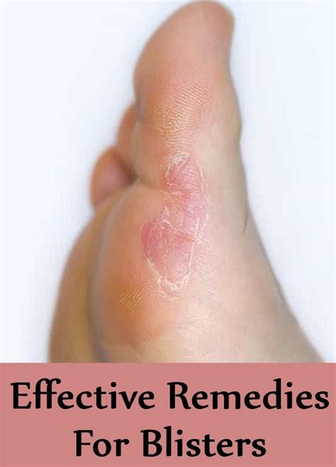 9 Effective Treatments For Blisters | Blister treatment, Blister remedies, How to treat blisters