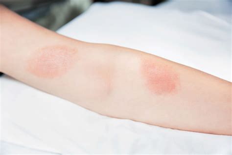 Itchy Blister Rash: Pictures, Causes, and Treatment