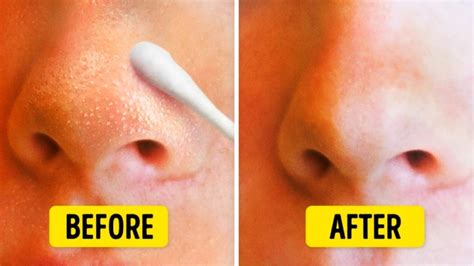 How To Remove Blackheads On Nose Naturally At Home – home