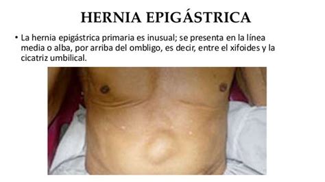 Hernia umbilical y epigastrica