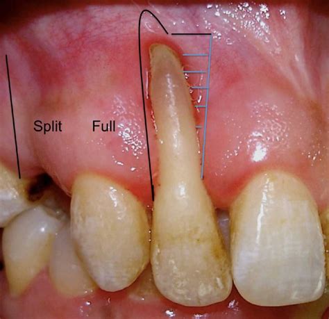 Exposed tooth root - What may I expect now | News | Dentagama