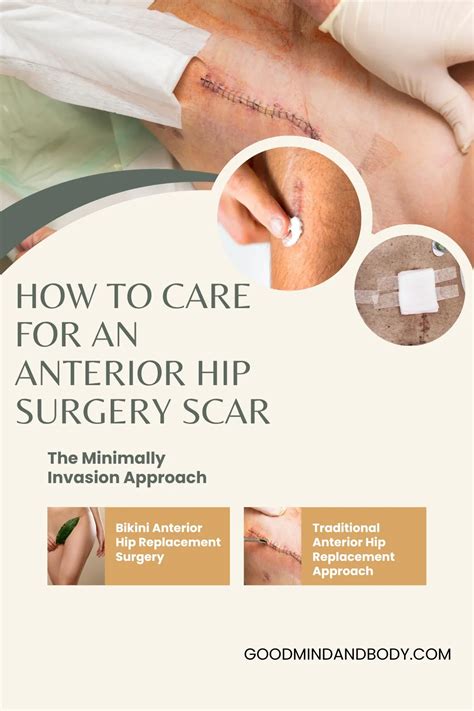 How to Care for an Anterior Hip Replacement Scar - Good Mind and Body