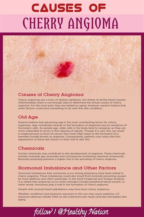 CAUSES OF CHERRY ANGIOMA in 2023 | Cherry angioma, Naturopathic ...