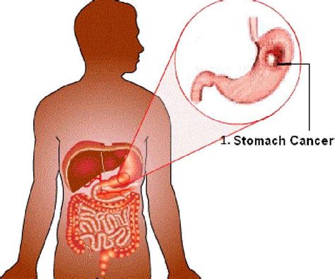 What Type Of Cancer Is Stomach Cancer - CancerWalls