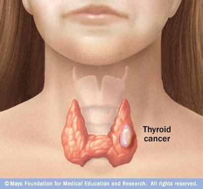 Thyroid Cancer - Physiopedia