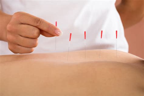 7 Things You Need To Know About Dry Needling — Revive Sport & Spine