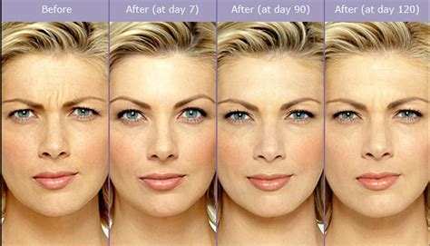 Botox Before And After Eyes