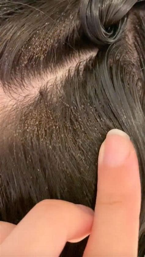 Girl had headlice so bad it took nine hours to get rid of them - HertsLive