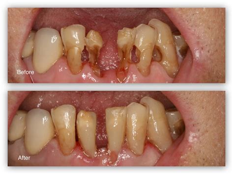 Tooth Cavity Filling Before And After