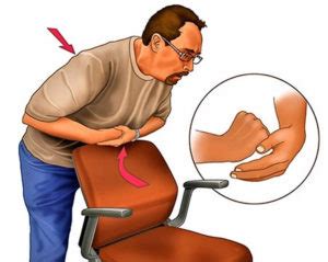 Heimlich maneuver - how to perform the Heimlich maneuver