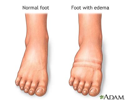 Foot, leg, and ankle swelling Information | Mount Sinai - New York