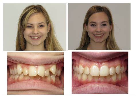 can overjet be corrected with invisalign - millerrlangland