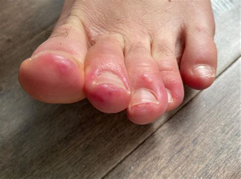 Spots On Toes And Rashes Join Weird New Symptoms Of Coronavirus - Virus Reports