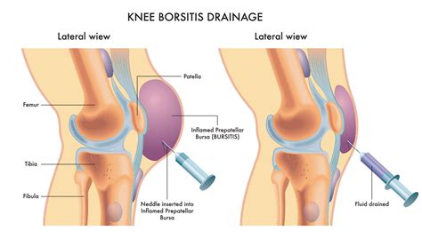 Bursitis | Knee Surgeon Dr A Theodorides - Symptoms, Diagnosis, Treatment