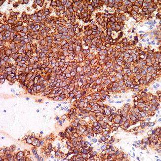 Myxoid Liposarcoma | Plastic Surgery Key