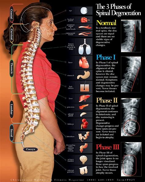 3 Phases of Spinal Degeneration Chiropractic Chart - Clinical Charts and Supplies