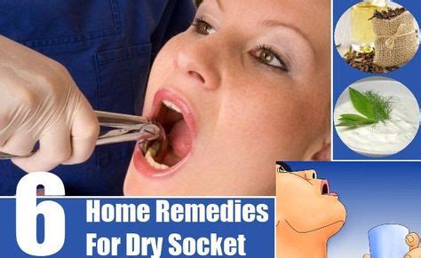 6 Best Home Remedies For Dry Socket | Dry socket, Home remedies, Remedies