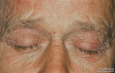 3-234 Psoriasis. Koebner phenomenon of the eyelids from Rockwool dust (1 of 2)