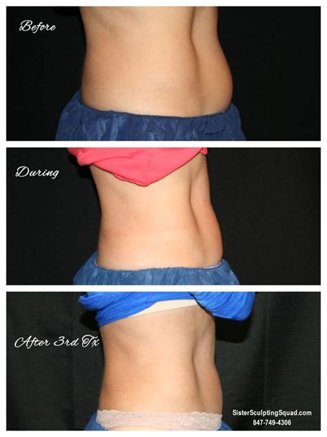 CoolSculpting Before & After Photos - Riverside Medical S.C