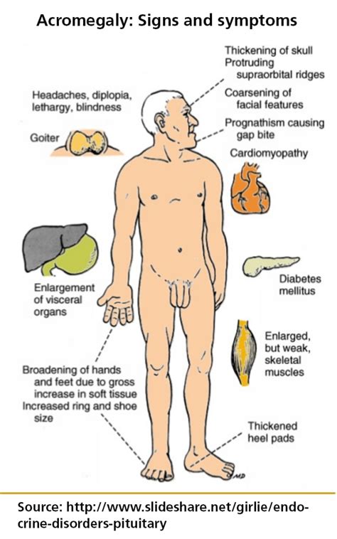 Acromegaly Treatment | Pacific Neuroscience Institute