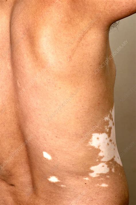 Vitiligo skin patches - Stock Image - C037/2184 - Science Photo Library