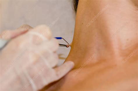 'acrochordon, ablation' - Stock Image - C002/7544 - Science Photo Library