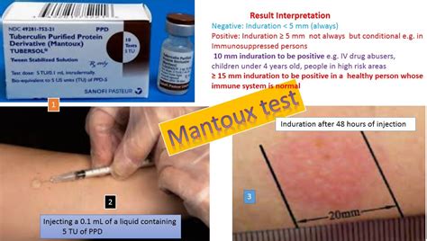 Tuberculin Skin Test: Introduction, Procedure, Normal Range and Result