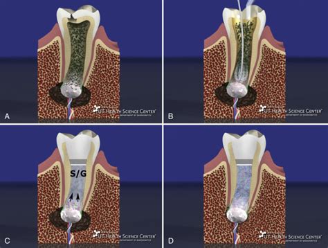 Regenerative Endodontics | Pocket Dentistry