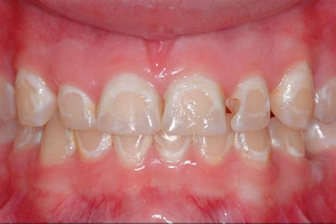 Enamel Hypoplasia: Causes & Treatment Essentials