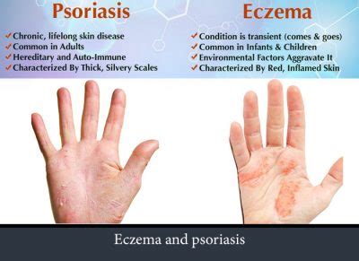 What are the differences between eczema and psoriasis? | Psoriasis expert