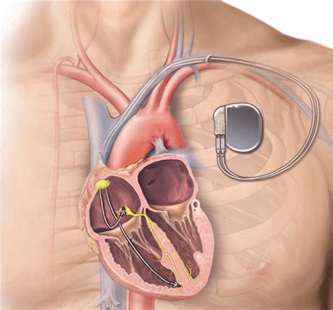 Inserting a pacemaker | healthdirect