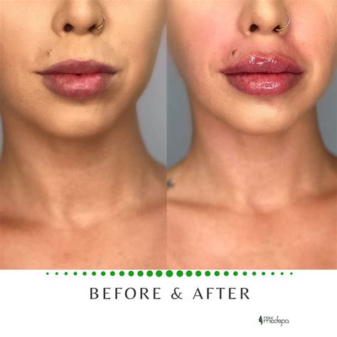 Lip Filler Before and After | Lip fillers cost, Lip fillers, Aesthetic ...