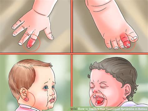 How to Prevent Hair Tourniquet Syndrome in Babies: 12 Steps