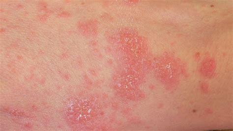 Rash In Groin Area Female : Inverse psoriasis or jock itch? Symptoms, triggers, and ... / While ...