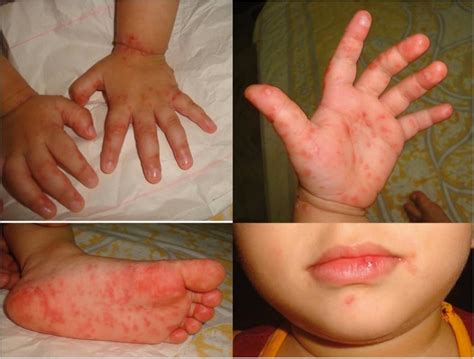 Prevent Your Kiddos From Spreading Hand, Foot, & Mouth Disease