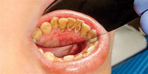 How to Prevent Plaque & Tartar Buildup On Teeth