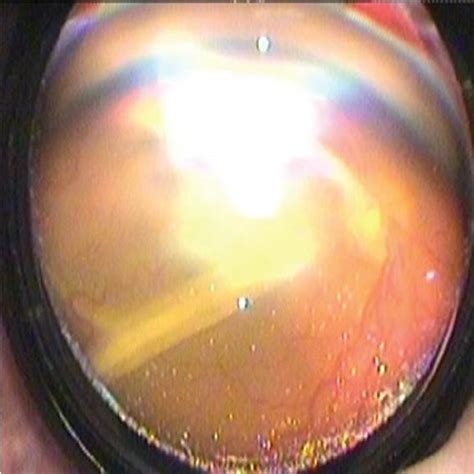 Exudative retinal detachment in right eye | Download Scientific Diagram