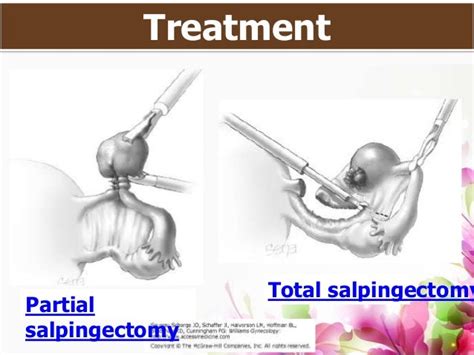 Ectopic pregnancy PBL