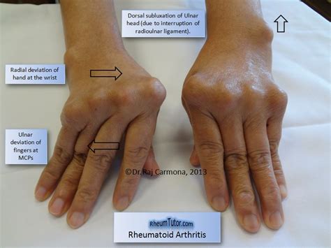 Rheumatoid Arthritis · RheumTutor