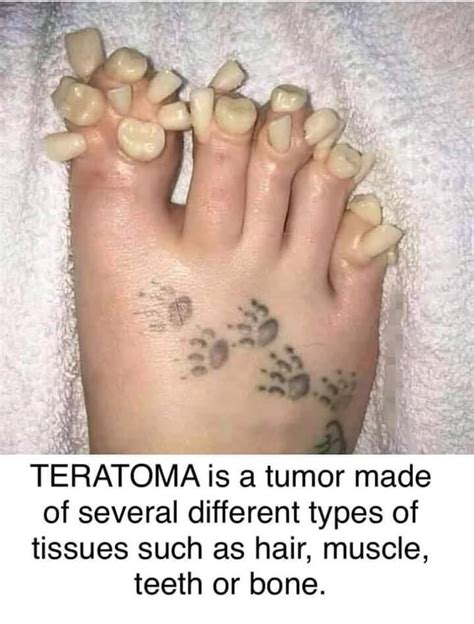 CPSP Trolls - TERATOMA TUMOR A teratoma is a tumor made up...