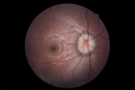 15 year old with optic neuritis : r/optometry