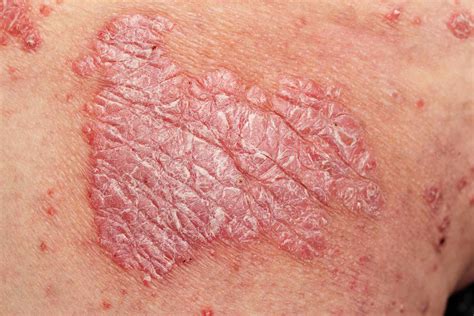 Is Psoriasis Contagious? Stigma, Facts, Reassurance