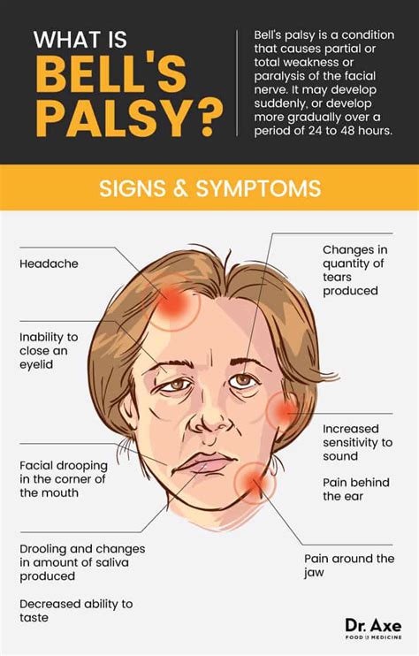 Bell's Palsy (+ 13 Natural Treatments for Bell's Palsy Symptoms) - Dr. Axe