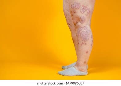 Dermatological Skin Disease Psoriasis Eczema Dermatitis Stock Photo 1479996893 | Shutterstock