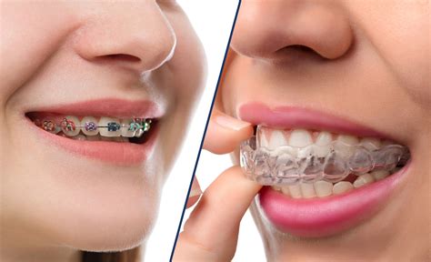 Invisalign vs. Braces- Which Orthodontic Treatment Is Best for You?