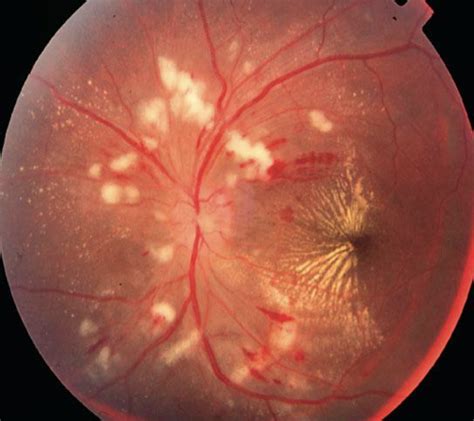 Hypertensive Retinopathy - OasisEye Specialists