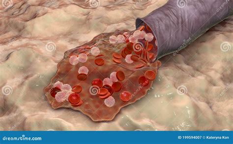 Blood flow, hemorrhage stock illustration. Illustration of flowing ...