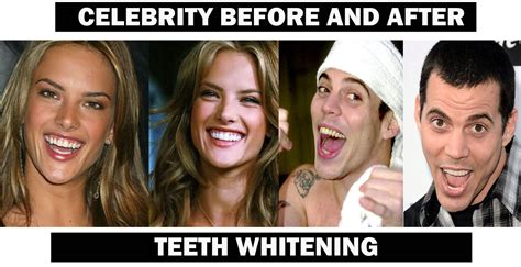 Celebrity Sexy Teeth Whitener - Masturbation Network
